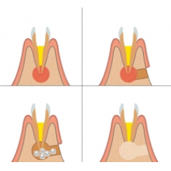 Что такое резекция зубного корня?