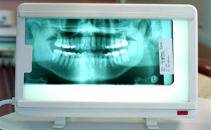 Стоматологические снимки рентген