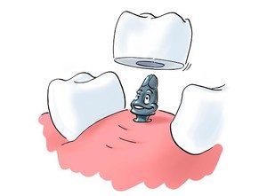 Все особенности имплантации зубов