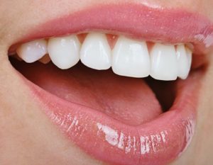 Что делать, если утрачен зуб?