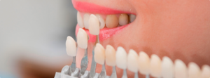Зубные виниры - новое слово в стоматологии