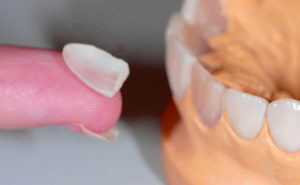 Протезирование на своих зубах