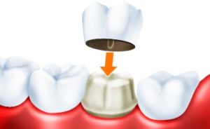 Что такое зубная коронка?