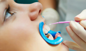 Противопоказания для реставрации зубов