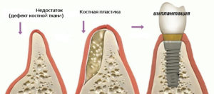 Наращивание костной ткани зуба