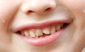 Сколы и трещины на эмали зубов
