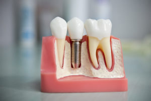 Современная имплантация зубов в Сумах