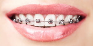Этапы ортодонтического лечения