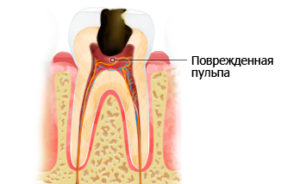 Почему болят зубы? Острая боль