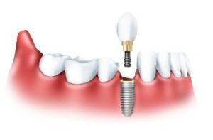 А что Вы знаете про имплантацию зубов?
