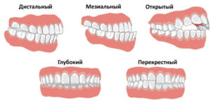 Лечение неправильного прикуса у ребенка