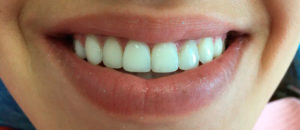 Наращивание зубов в стоматологии