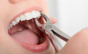 Осложнение после удаления зуба